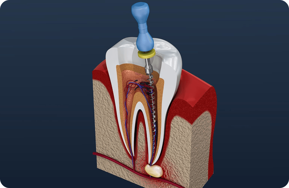 Root canal treatment