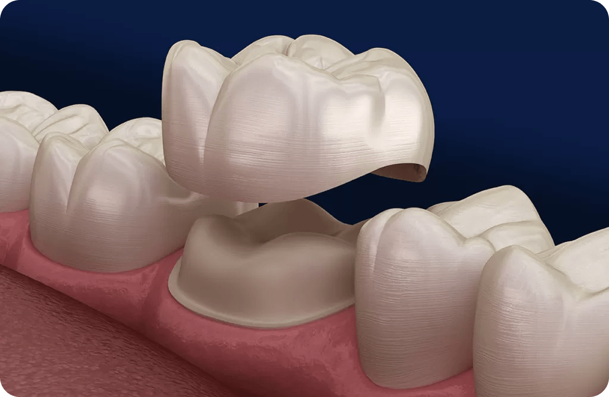 Dental crowns
